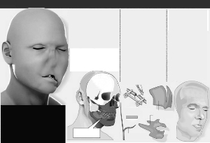 整脸移植手术过程示意图